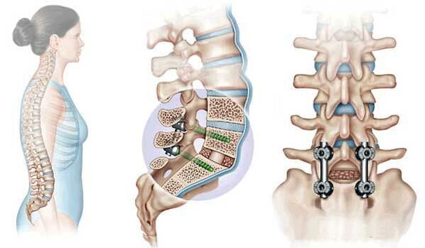 Implants to fix displaced vertebrae in advanced stages of osteochondrosis