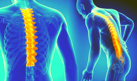 Osteochondral disease of the spine