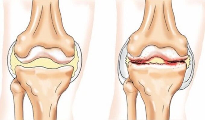 Differences between arthritis and arthritis