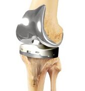 Joint prosthesis