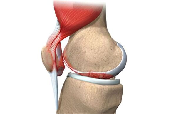 Complications of joints