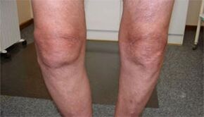 Symptoms of Arthropathy