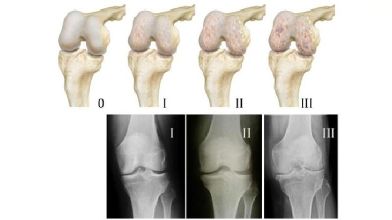 X-ray shows staging of knee arthritis