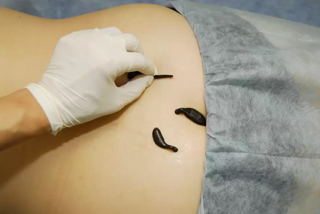 Leech placement to treat lumbar osteochondrosis