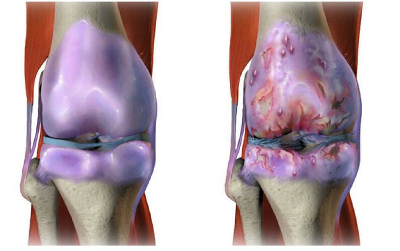 Destruction of healthy cartilage and joint disease in the knee joint