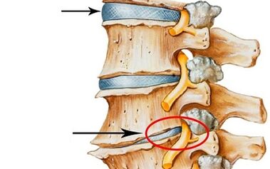 Development stages of cervical osteochondrosis