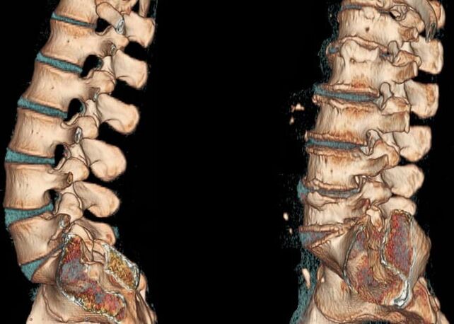 CT scan of lumbar spine for normal conditions and osteochondrosis