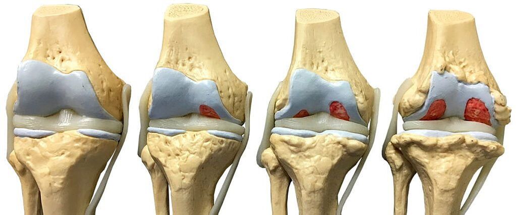 Degree of arthropathy of the knee joint