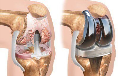 Knee Prosthesis and Knee Arthropathy
